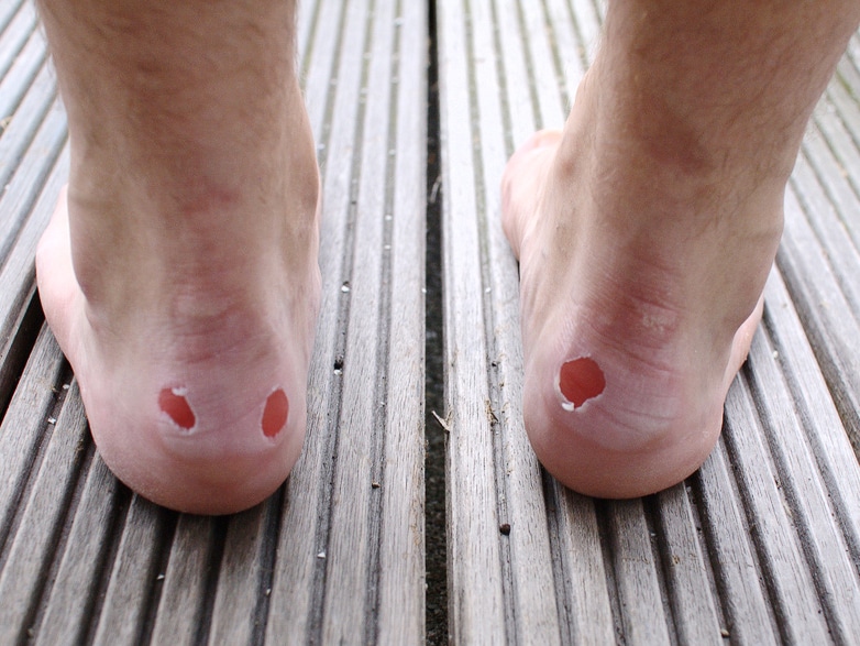 blisters